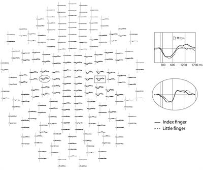 Lack of Cortical Correlates of Response Inhibition in 6-Year-Olds Born Extremely Preterm – Evidence from a Go/NoGo Task in Magnetoencephalographic Recordings